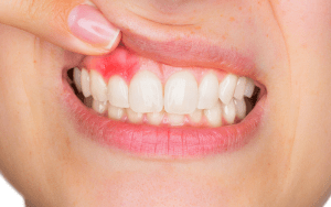 Vnetje dlesni povzroča zadah iz ust
